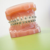 Selbstlegierende Brackets