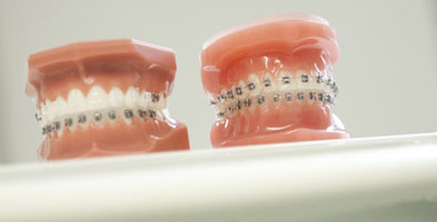 Selbstlegierende Brackets